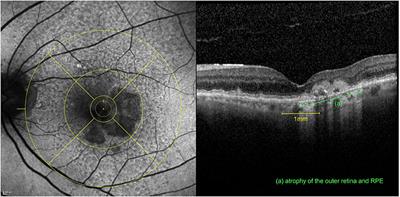 Strongest Correlation Between Contrast Sensitivity and Morphological Characteristics in Bilateral nAMD